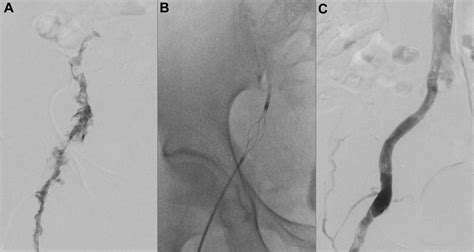 Mechanical Thrombectomy With Trerotola Compared With Catheter Directed