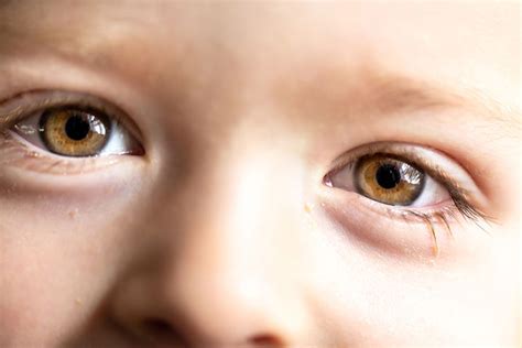 11 Signs And Symptoms Of Blepharitis In Babies And Toddlers