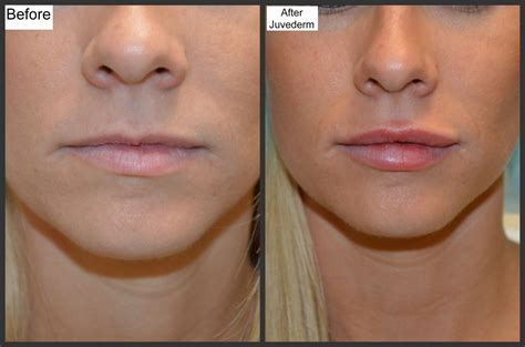 Lip Fillers Before And After Thin Lips