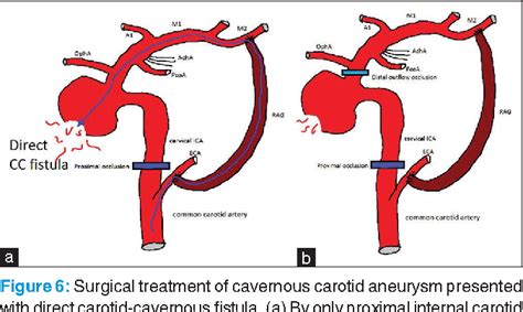 Figure 6 From Surgical Treatment Of Large And Giant Cavernous Carotid