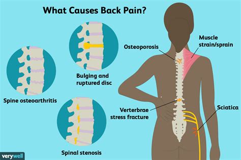 Lower back pain has a wide variety of causes. Back Pain: Causes, Treatment, and When to See a Doctor