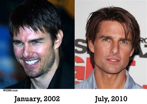Tom Cruise Teeth Before And After