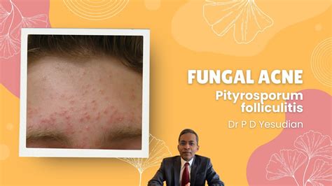 Pityrosporum Or Malassezia Folliculitis Fungal Acne Youtube