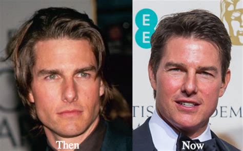 Tom Cruise Plastic Surgery Before And After