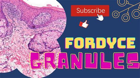Fordyce Granules Oral Pathology Lectureshafers Ninth Edition Youtube