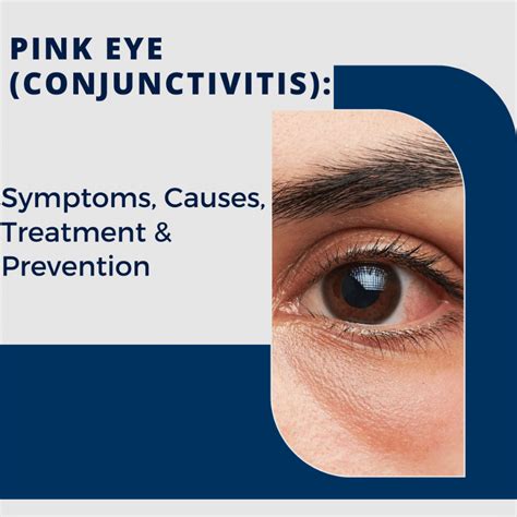 Pink Eye Conjunctivitis Symptoms Causes Treatment And Prevention