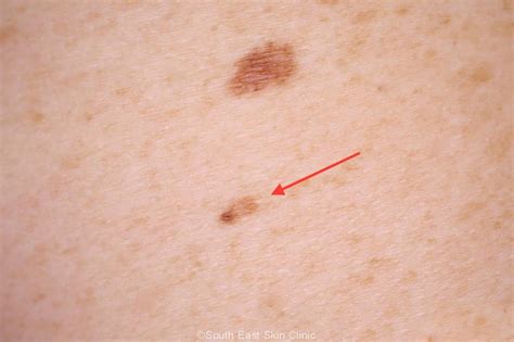 A Guide To The Atypical Mole South East Skin Clinic