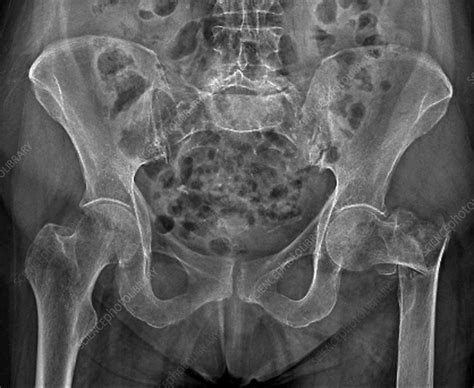 Fractured Hip Joint X Ray Stock Image C0337357 Science Photo