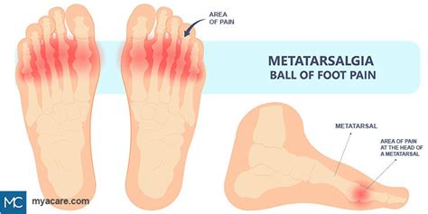 Dropped Metatarsal Causes Symptoms And Treatment Mya Care