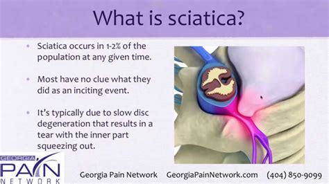 Indications For Sciatica Surgery Explained By A Georgia Pain Management