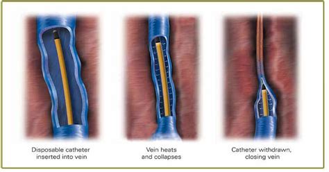 A Nice Introduction To Endothermal Ablation Learn More Now