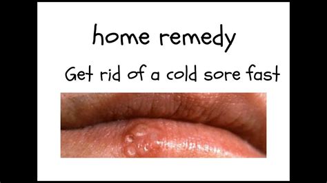 How To Get Rid Of Cold Sores Fast Quick Diy Tips Get Rid Of Cold
