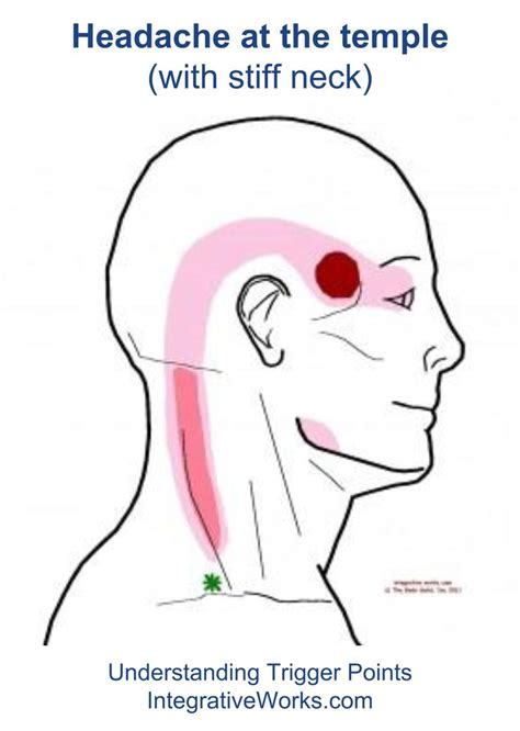 34 Best Images About Headache Trigger Point Pain On Pinterest
