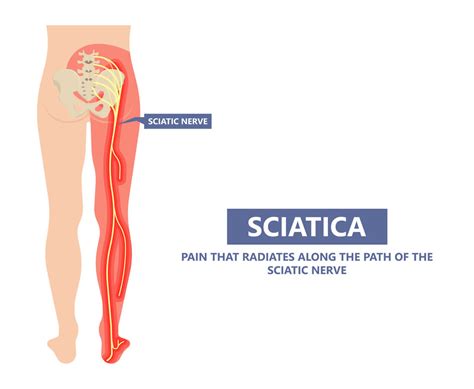 Sciatica And What You Need To Know ACC