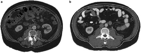 Examples Of Abdominal Ct Images At The Level Of The Third Lumbar
