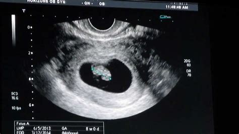 8 weeks ultrasound doovi