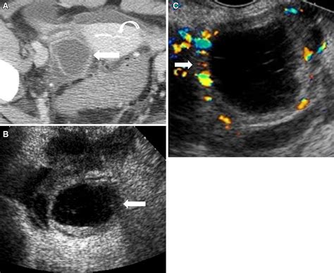 Radiological Appearances Of Corpus Luteum Cysts And Their Imaging Mimics Semantic Scholar