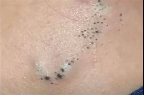 Blackheads And Cysts Goldmine On The Back New Pimple Popping Videos