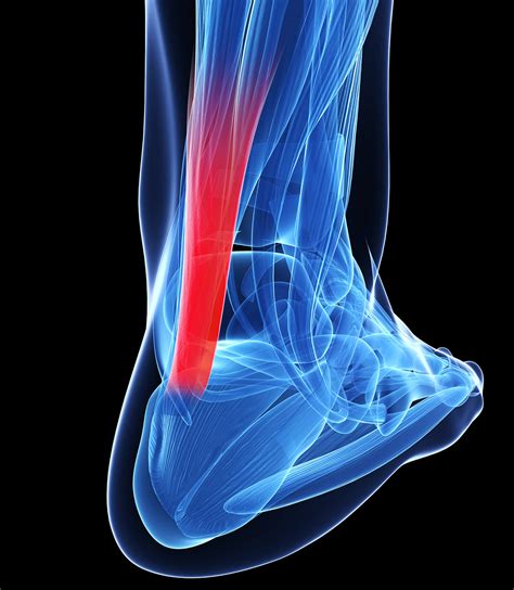 Tratamento Da Tendinose Lesões Tendinosas Northeast Knee And Joint