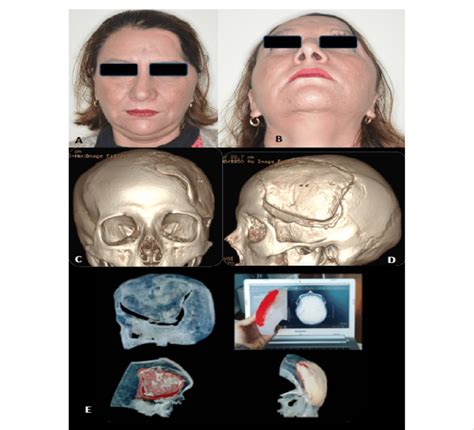 A And B Preoperative Frontal View Of Patient With Download