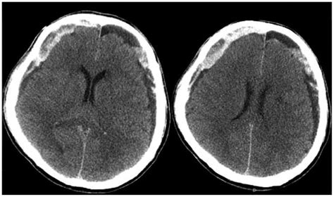 Ct Scans Of Case 4 There Are Bilateral Subdural Hematomas Download