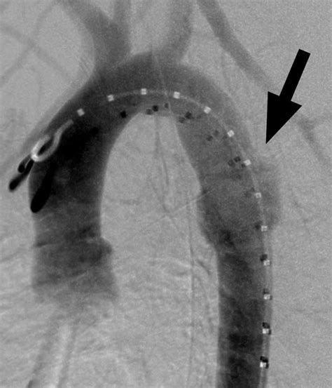 Technique For Percutaneous Transfemoral Stent Graft Repair Of Traumatic