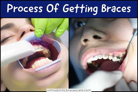 Process Of Getting Braces Steps How Long It Takes Orthodontic
