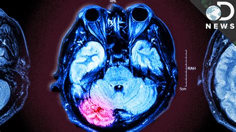 What should you do if you think you have had a concussion? brainandspinalcord.org: How Repeated Concussions Damage Your Brain Forever - YouTube