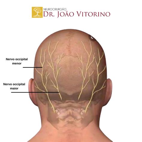 Neuralgia Occipital Dr João Vitorino