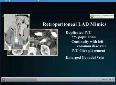Throat cancer usually starts on the low cells present on the inside of a person's throat. rsna: cancer mimics, abdomen