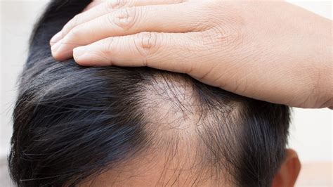 Alopecia Areata O Que Causas Sintomas E Tratamento