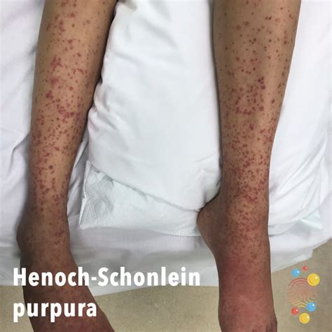 Henoch Schonlein Purpura Skin Deep