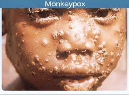 The monkeypox virus is a member of the same family of viruses as smallpox, although it is much less severe and experts say chances of infection are low. Monkeypox: Kwara begins sensitisation in hospitals, LGs ...