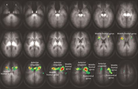 Abnormal Fmri Brain Activation In Euthymic Bipolar Disorder Patients