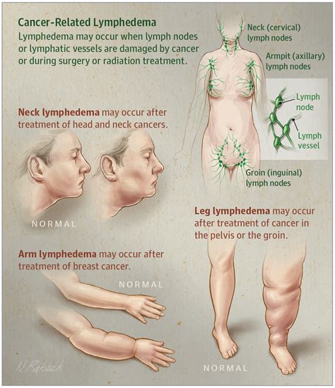Helping Cancer Patients Handle Lymphedema After Surgery Au Health News