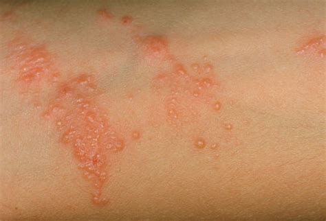 Red Itchy Bumps On Skin Causes Symptoms Pictures Treatment HealthMD