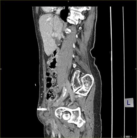 De Garengeots Hernia In An Elderly Woman As A Diagnostic Challenge A Review Of Literature