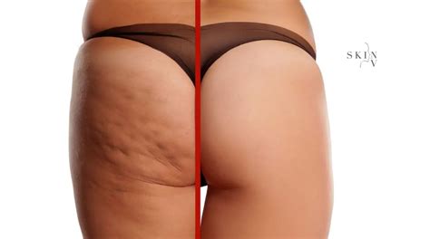 the truth about cellulite causes and prevention skin nv clinic