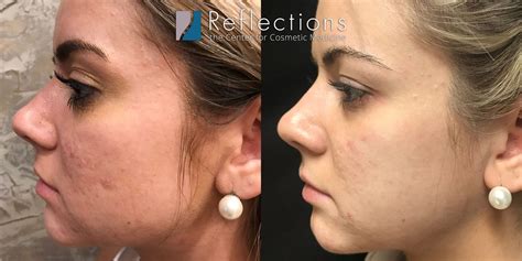 Rf Microneedling For Acne Scars Results Super Charged Before And After