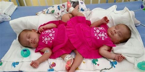 Conjoined Sisters Separated In Rare Surgery Ximena And Scarlett