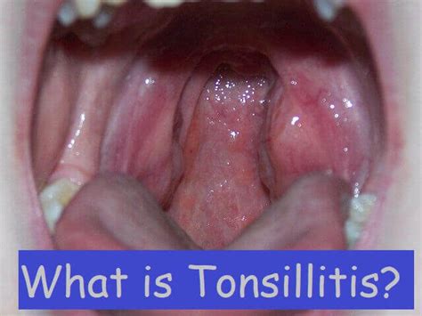 What Is Tonsillitis Causes Symptoms And Effective Remedies Expert