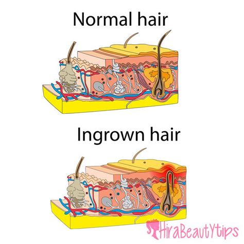 It is common after shaving your underarms and should go away on its own. How to get rid of ingrown hair on face | Ingrown hair ...