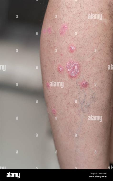 Psoriasis Vulgaris Skin Patches Are Typically Red Itchy And Scaly