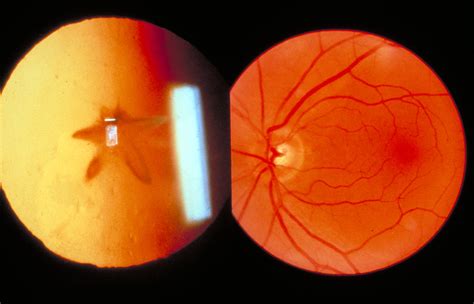 Ophthalmoscopytraumatic Cataract Left Normal Fundus R Flickr