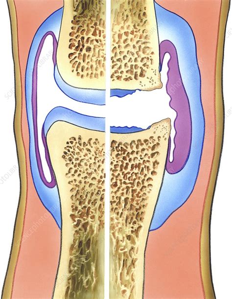 Osteoarthritis Of The Knee Artwork Stock Image C0076917 Science
