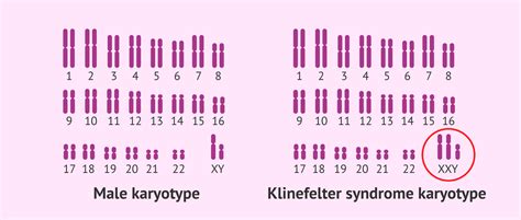 Normal Karyotype And Klinefelter Syndrome