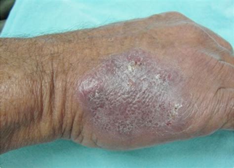 Figure 2 From An Atypical Presentation Of Erythema Elevatum Diutinum