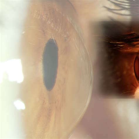 The Corneal Disease Keratoconus