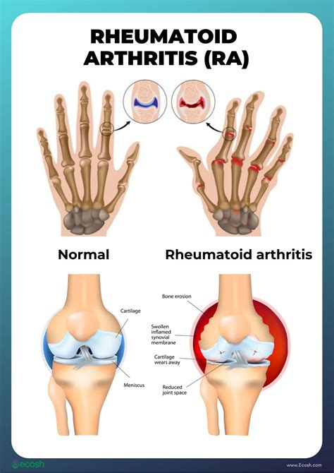 Rheumatoid Arthritis Rash Treatment