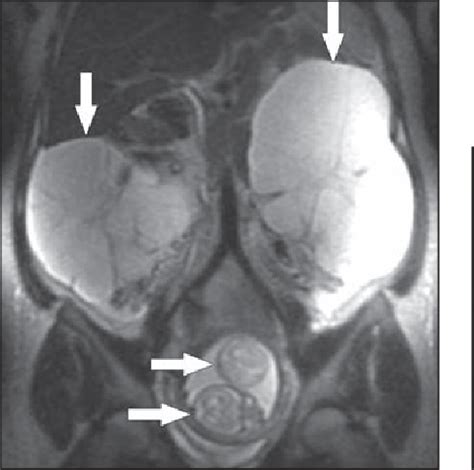 Figure 9 From MRI Of Adnexal Masses In Pregnancy Semantic Scholar